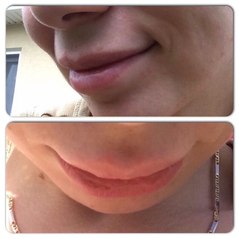 Увеличение губ усы гиалуроновые. Неудачное увеличение губ. Асимметрия губ после филлера. Асимметрия после увеличения губ филлером.