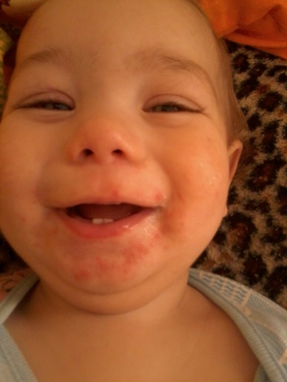 Ужасная сыпь.