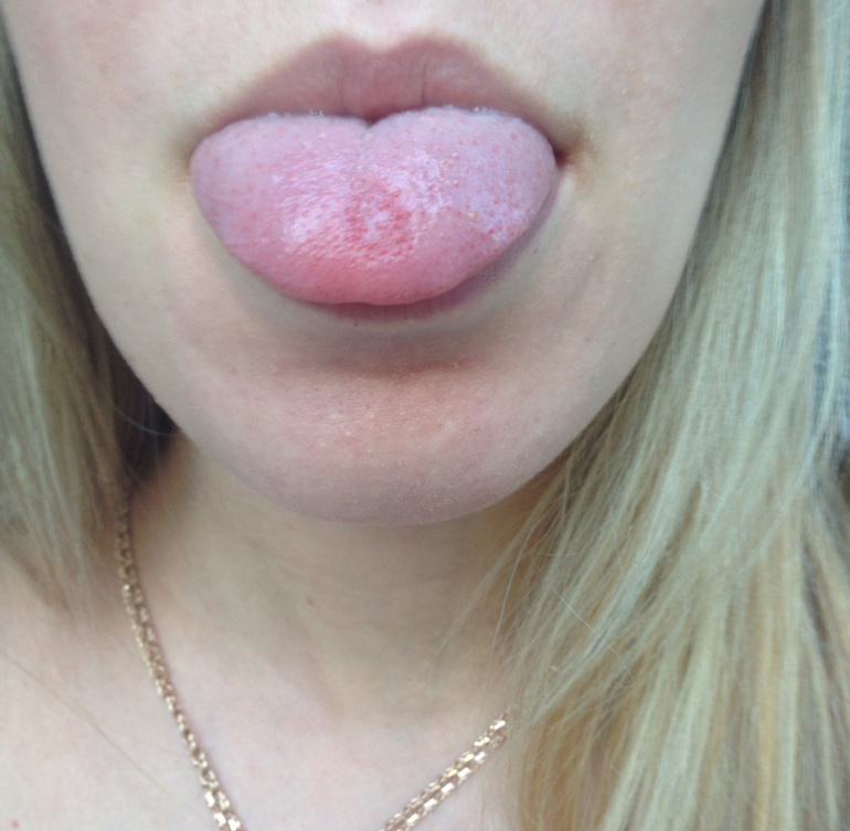 Пятно на языке