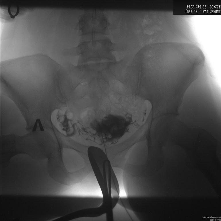 ГСГ есть надежда?