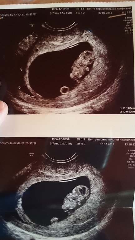 Наша малявка и киста