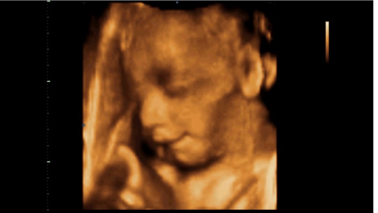 Узи, 31 неделя и 1 день.