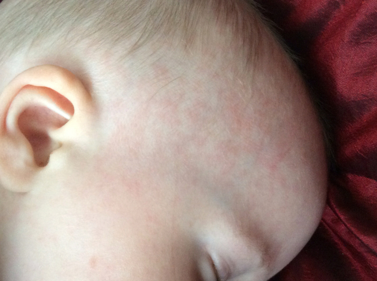 Что за прыщи??