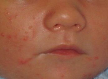 Потница или аллергия?