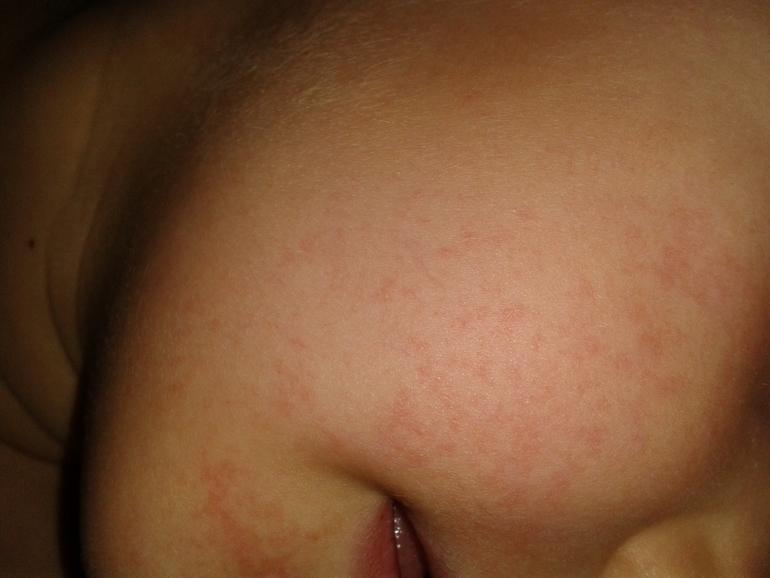 сыпь на лице