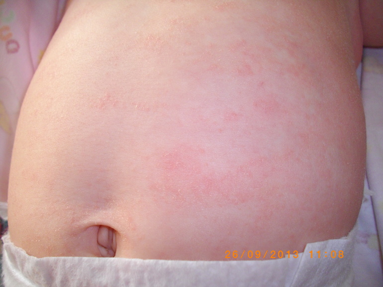 Сыпь....Может кто то знает что это такое, оно еще и шелушится....