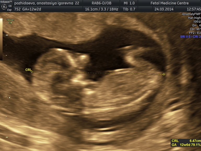 13-ая - 15 -ая недельки (22.03.2014-05.04.2014)