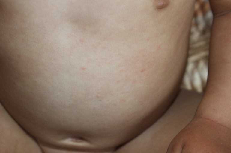 Потница или аллергия?