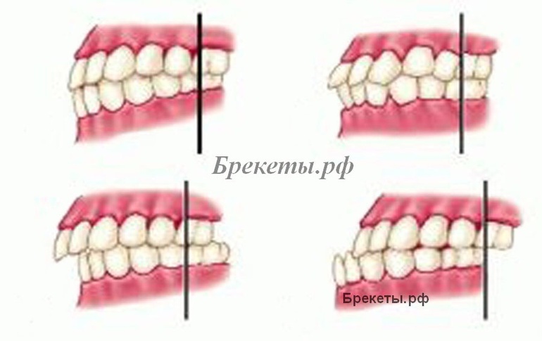 Ровные зубы с помощью брекет-системы Insignia